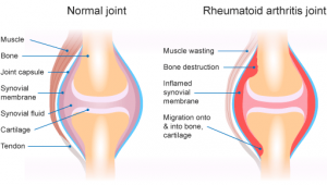 rheumatoid-arthritis-diagram